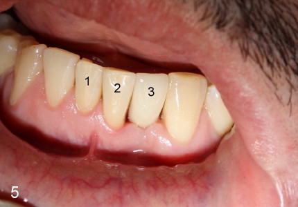 front tooth root canal