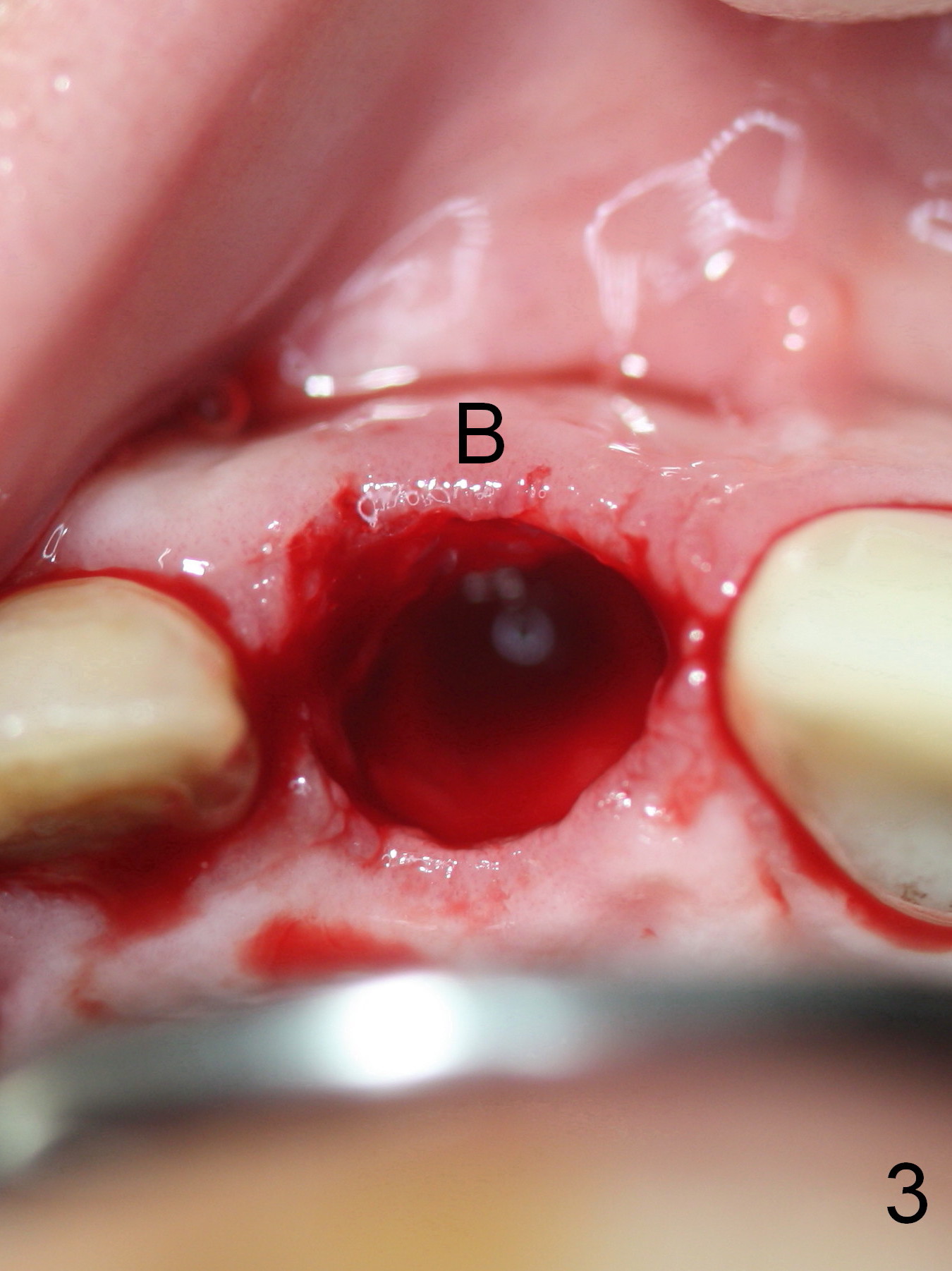 Immediate Implant of Upper Incisor with root fracture and ...