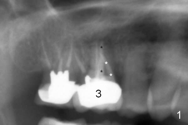 Immediate Implant of Upper 1st Molar, Dental Education ...