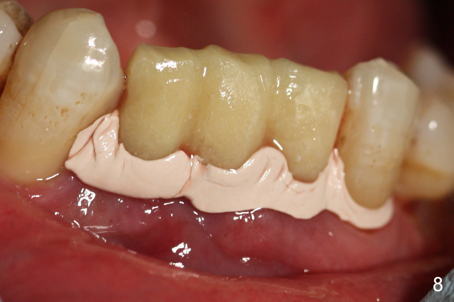 periodontal dressing