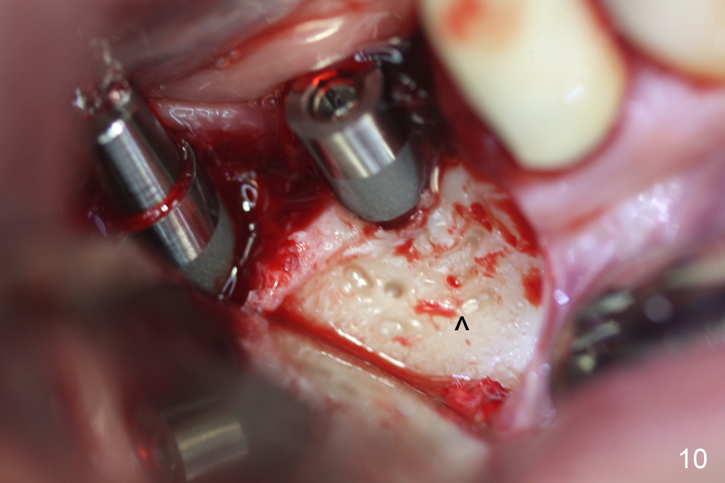 Immediate Implant Of Lower 2nd Molar With Change In Position And